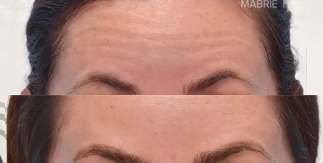 Botox Frente